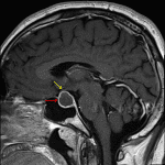 The lesion demonstrates peripheral enhancement (red arrow) and contacts and mildly uplifts the optic chiasm (yellow arrow).
