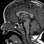 Ectopic posterior pituitary at the base of the pituitary stalk (red arrow) with hypoplastic appearance of the pituitary stalk (yellow arrow) and possibly also of the adenohypophysis (blue arrow).