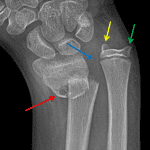 Galeazzi fracture/dislocation with a distal radial fracture (red arrow) and distal dislocation of the ulna (blue arrow) with widening of the distal radioulnar joint. There is also an ulnar styloid fracture fragment (yellow arrow) which is displaced radially from its donor site (green arrow).