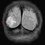 FLAIR hyperintense, expansile lesion in the right occipital lobe (red arrow).