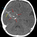 Peripherally-calcified lesion along the right temporal lobe (red arrows) with adjacent subarachnoid (yellow arrow) and subdural (blue arrow) hemorrhage.