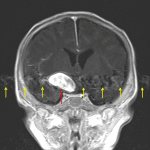 Diffuse internal enhancement on postcontrast imaging (red arrow) with corresponding radiating pulsation artifact (yellow arrows).