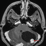 Cystic mass in the left cerebellar hemisphere with an avidly enhancing mural nodule (red arrow).