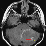 Axial FLAIR sequence demonstrates hyperintense signal within the solid component (red arrow) contrasted with serpiginous hypointense flow voids (yellow arrows). Minimal parenchymal edema is noted along the margins of the cystic component of the mass (blue arrow).