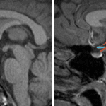 Relevant anatomic structures on a midline sagittal image in and around the hypothalamus: purple - anterior commissure, pink - lamina terminalis, blue - optic chiasm, orange - pituitary infundibulum, green - tuber cinereum, yellow - mammillary body.