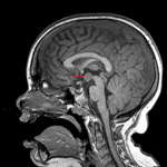 Rounded mass centered on the floor of the third ventricle which is isointense to gray matter (red arrow), consistent with a hypothalamic hamartoma.