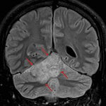 T2/FLAIR hyperintense mass in the superior aspect of the right cerebellar hemisphere and vermis (red arrows).
