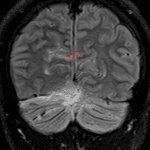 FLAIR signal hyperintensity in a right occipital sulcus (red arrow), which may also relate to leptomeningeal tumor dissemination.