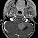 Enhancing mass centered in the left cerebellar hemisphere (red arrow) with a peripheral cystic component (yellow arrow).