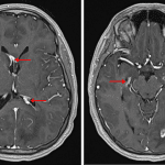 Multiple sites of nodular enhancement along the margins of the lateral ventricles (red arrows) in this patient with neurosarcoidosis.