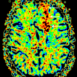 Cerebral blood volume map demonstrates relatively elevated cerebral blood volume corresponding to the left frontal mass (white arrows).