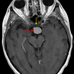 Diffuse corresponding enhancement (red arrow). The mass contacts the posterior aspect of the optic chiasm (yellow arrow).