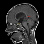 Dominant mass in the pineal region (red arrow) with a smaller mass anteriorly centered in the anterior recesses of the third ventricle (yellow arrow).