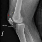 Quadriceps avulsion injury with multiple small fracture fragments displaced superiorly to the patella (red arrow), a moderate-sized hemarthrosis (yellow arrow), and a thickened/bunched appearance of the patellar tendon (blue arrow).
