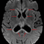Diffuse rim of restricted diffusion around the ventricles (red arrows), which is a typical appearance for secondary CNS lymphoma.