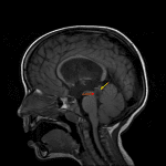 T1 hypointense tectal mass (red arrow) with associated obstructive hydrocephalus at the level of the cerebral aqueduct. A rim of normal parenchyma along its superior margin (yellow arrow) helps exclude a pineal origin of this particular mass.