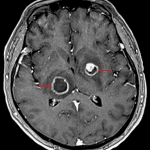 Peripherally-enhancing lesions in the right thalamus and left lentiform nucleus (red arrows).