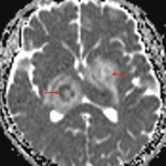 Peripheral restricted diffusion, more pronounced with the right thalamic lesion (red arrows).