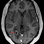 Peripherally-enhancing lesion in the right occipital lobe (red arrow) with surrounding vasogenic edema.