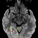 Faint corresponding central restricted diffusion (red arrow) as well as faint restricted diffusion along the periphery of the surrounding vasogenic edema (yellow arrows).