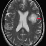 Masslike area of T2 signal hyperintensity in the left frontal white matter (red arrow) with surprisingly essentially no mass effect on the left lateral ventricle or adjacent sulci.