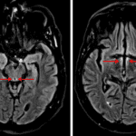 Areas of faint FLAIR signal hyperintensity in the periaqueductal gray matter and medial aspects of the thalami and hypothalamus (red arrows), which can be seen with Wernicke encephalopathy.