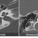 Unwound appearance of the cochlea in branchio-oto-renal syndrome (red arrow).