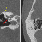 Dysplastic stapes elements adjacent to a stenotic oval window (left image, red arrow). Dehiscent superior semicircular canal (yellow arrow). Dysplastic posterior semicircular canal with possible dehiscence into the adjacent jugular bulb (right image, red arrow).