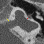 Cystic, fused appearance of the cochlea and vestibule (red arrow) with a broad communication with the IAC (yellow arrow).
