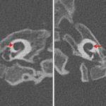 Bilateral cochlear hypoplasia with poor development of the apical turns (red arrows).
