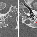Normal course of the mastoid segment of the right facial nerve (image on the right, green arrow). Abnormal splitting of the mastoid segment of the left facial nerve with a larger canal coursing anteriorly (image on the right, red arrows).