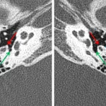 Normal right (image on the left and abnormal left (image on the right) middle ears. Blunted appearance of the pyramidal eminence (red arrows) and shallow appearance of the facial recess (blue arrows) on the left. Green arrows indicate the sinus tympani.