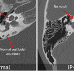 Incomplete partitioning of the apical and middle turns of the cochlea in IP-II with loss of the usual notch along their lateral margin at the site of attachment of the interscalar septum. There is also enlargement of the vestibular aqueduct, which is commonly associated with IP-II.