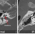 Absent modiolus and lamina cribrosa in IP-III.