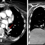 Soft tissue attenuation material filling left lower lobe bronchi (red arrows), most concerning for large volume aspiration.