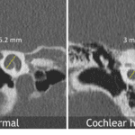 Think of cochlear hypoplasia when the cochlear height measures less than 4.3 mm in the coronal plane.