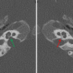 Severely stenotic left cochlear aperture (red arrow) in contrast to the normal right cochlear aperture (green arrow).