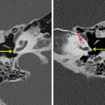 The majority of the left cochlea is nearly invisible (red arrow) in contrast to the normal-appearing right cochlea. The cochlear promontories are symmetric and convex bilaterally (yellow arrows).