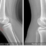 A normal Insall-Salvati ratio is 0.8-1.2. In the case to the right, this ratio measures 2, indicative of patella alta.