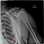 Acute nondisplaced fractures of the left lateral third and fifth ribs (red arrows).