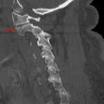 Acute fracture of the anterior superior corner of the left C2 lateral mass (red arrow).