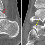 A followup CT on this patient demonstrates the nondisplaced posterior process of talus (red arrow) and anterior process of calcaneus (yellow arrow) fractures.