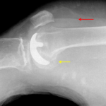 Cortical offset adjacent to the distal femoral hardware consistent with periprosthetic fracture (yellow arrow). Fat fluid level anterior to the distal femur consistent with lipohemarthrosis (red arrow).