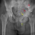 Fractures of the left acetabulum extending into the iliac bone (red arrows). Additional fractures of the left pubic root/superior ramus and inferior ramus (yellow arrows).