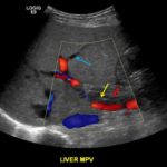 Areas without Doppler signal in the main portal vein indicate nonocclusive thrombus (yellow arrow). Nonfilling of left portal venous branches (e.g. blue arrow) indicate areas of occlusive thrombus.
