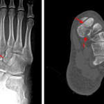 Red arrows demonstrate the comminuted fracture involving the medial cuneiform on x-ray and on the subsequent CT.