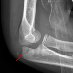 A radiograph from one month prior shows the olecranon fracture when it was acute (red arrow).