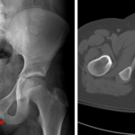 Yellow arrow indicates the superior pubic ramus fracture. Red arrows on the x-ray and CT indicate the inferior pubic ramus fracture.
