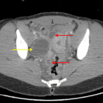 Dilated bilateral uterine tubes with wall thickening and enhancement (red arrows). There is also a peripherally enhancing structure in the right ovary concerning for abscess (yellow arrow).