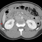 Trace perihepatic free fluid (red arrow).